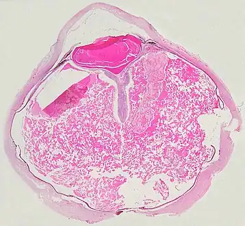 A case of Coats' disease, showing total exudative retinal detachment, and subretinal exudate containing cholesterol crystals (H&E)