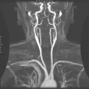 Maximum intensity projection of an MRA covering from the aortic arch to just below the circle of Willis