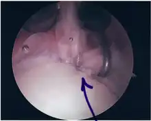 Repair of SLAP Tear