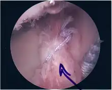 Repair of SLAP tear